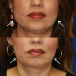 masseter botox vorher nachher