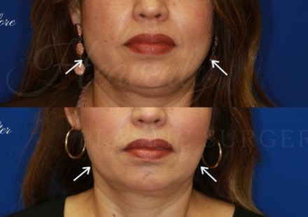 masseter botox vorher nachher
