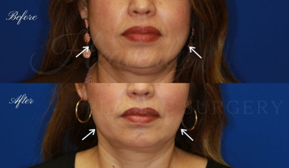 masseter botox vorher nachher