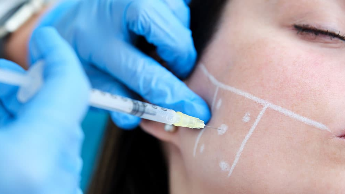 masseter botox vorher nachher