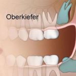 5 tage nach weisheitszahn-op noch schmerzen