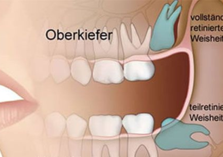 5 tage nach weisheitszahn-op noch schmerzen